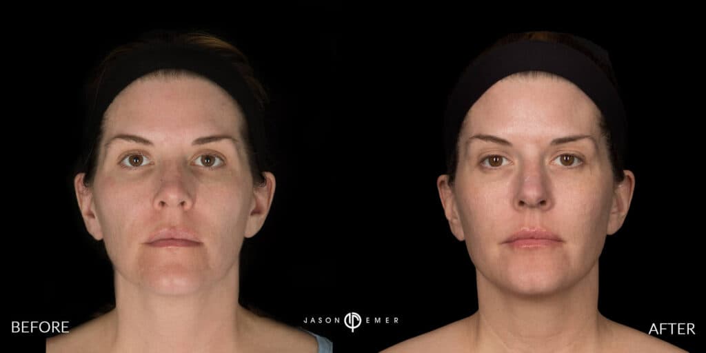 Microneedling Gallery