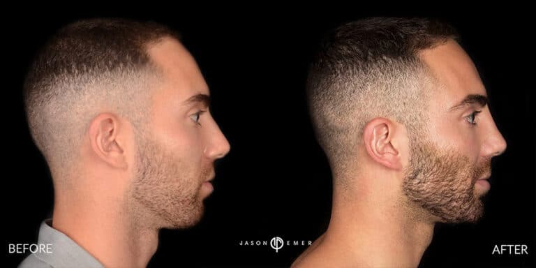 FACIAL SCULPTING MALE GALLERY 01