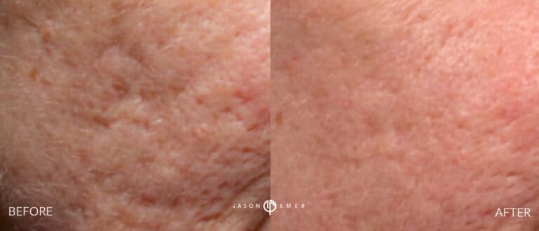 ACNE SCAR TREATMENT GALLERY 13