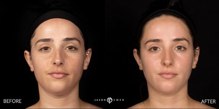 CHEMICAL PEELS GALLERY 01