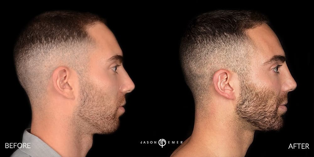 FACIAL SCULPTING GALLERY