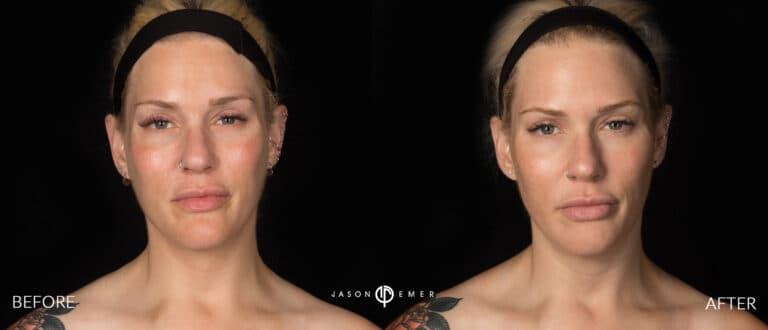 DERMAPLANING GALLERY 01