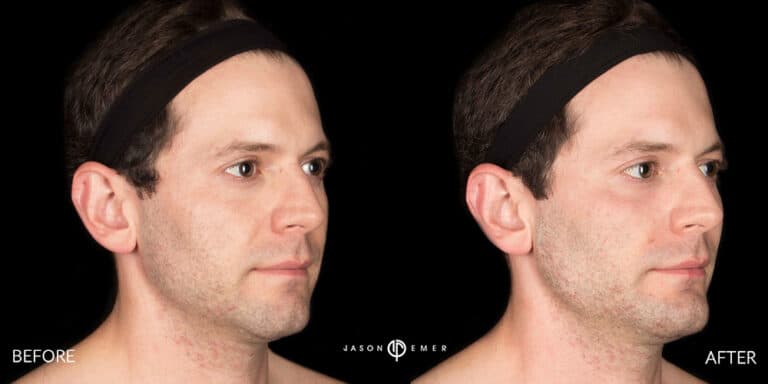 FACIAL SCULPTING MALE GALLERY 02