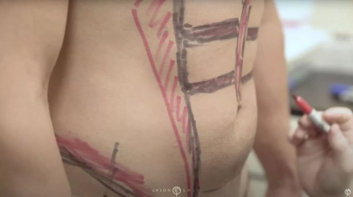 360-degree HD liposculpting and abdominal etching result by Dr. Jason Emer