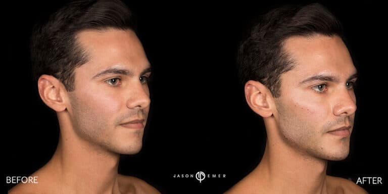 FACIAL SCULPTING MALE GALLERY 03