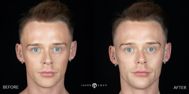 FACIAL SCULPTING MALE GALLERY 04