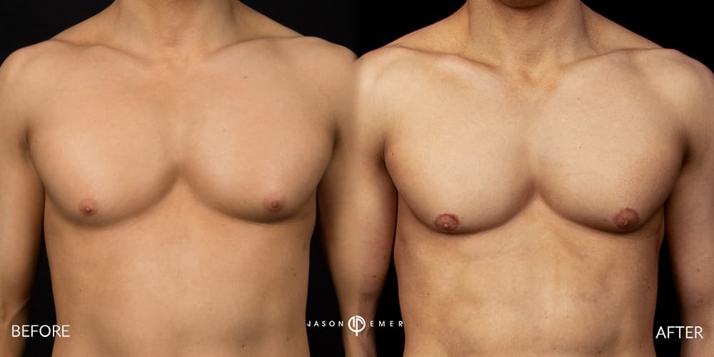 Chest Male Gallery