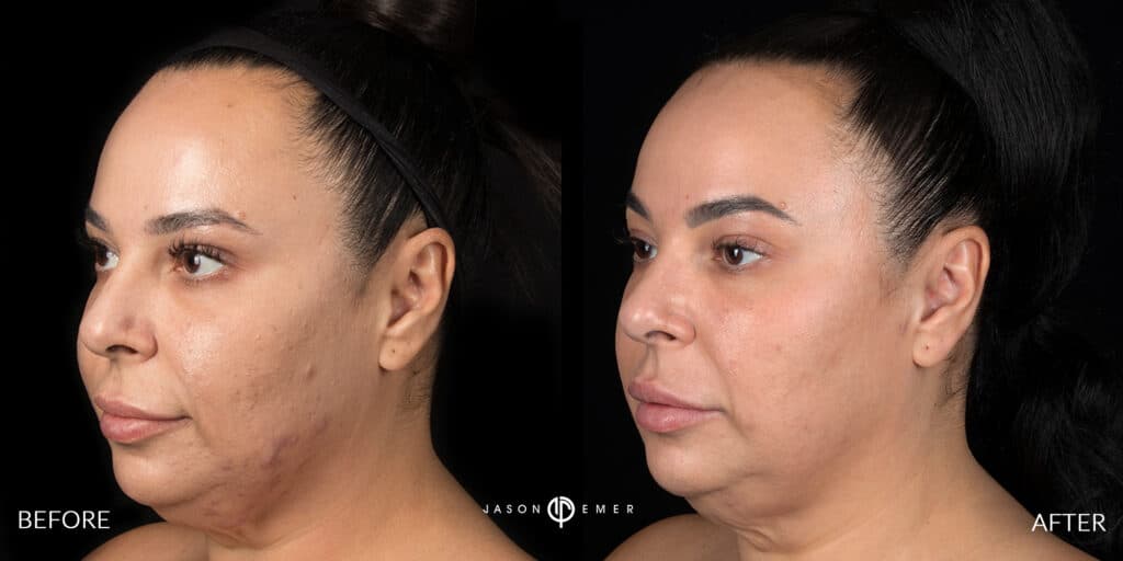 Melasma