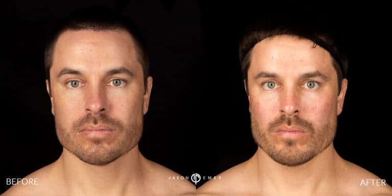 FACIAL SCULPTING MALE GALLERY 06