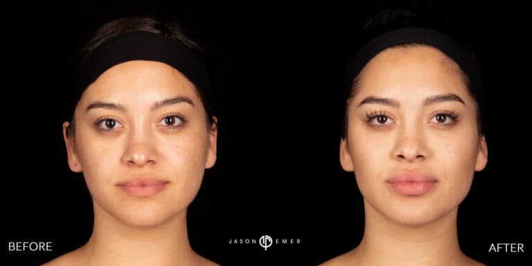 FACIAL SCULPTING FEMALE GALLERY 03