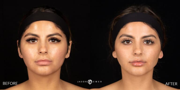 FACIAL SCULPTING FEMALE GALLERY 07