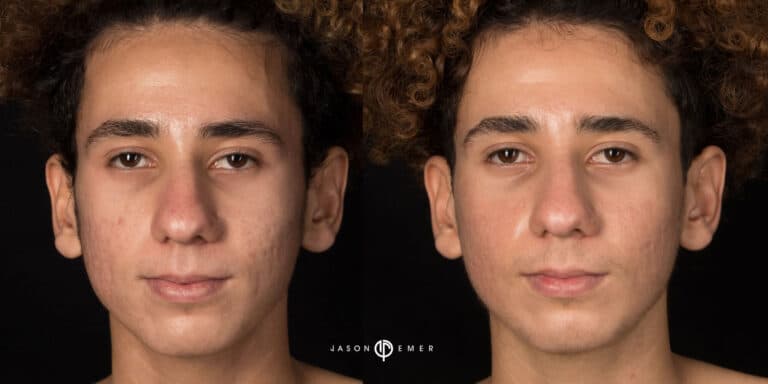 ACNE SCAR TREATMENT GALLERY 03