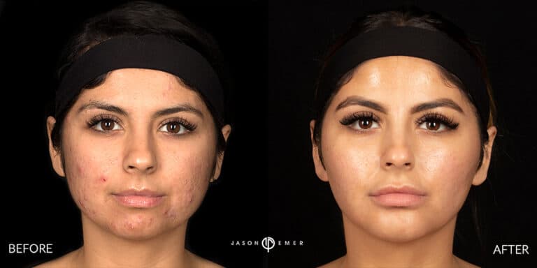 ACNE SCAR TREATMENT GALLERY 04