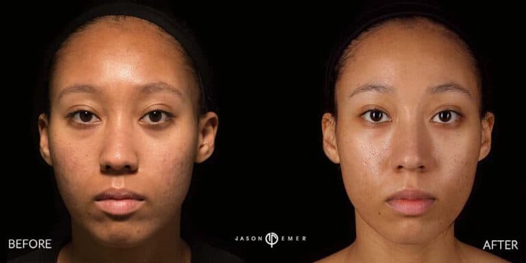 ACNE SCAR TREATMENT GALLERY 05