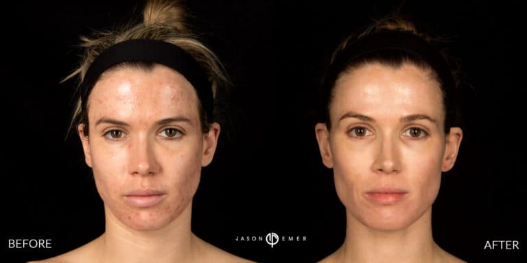 ACNE SCAR TREATMENT GALLERY 06