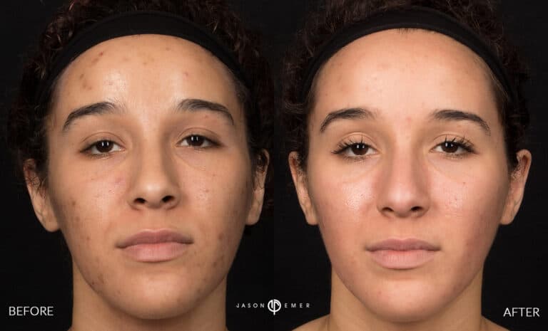 ACNE SCAR TREATMENT GALLERY 08