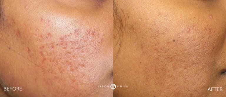ACNE SCAR TREATMENT GALLERY 10