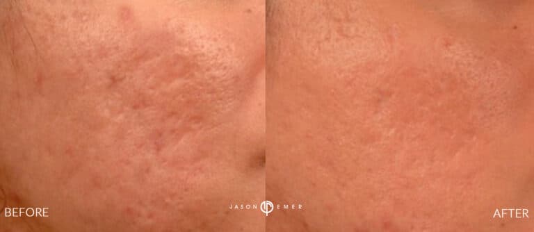 ACNE SCAR TREATMENT GALLERY 14