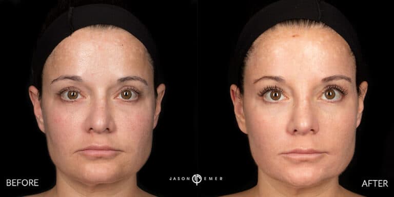 CHEMICAL PEELS GALLERY 04