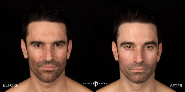 CHEMICAL PEELS GALLERY 17