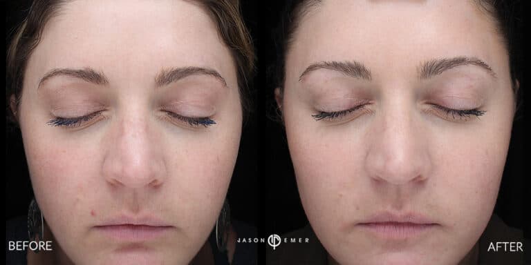 DERMAPLANING GALLERY 02
