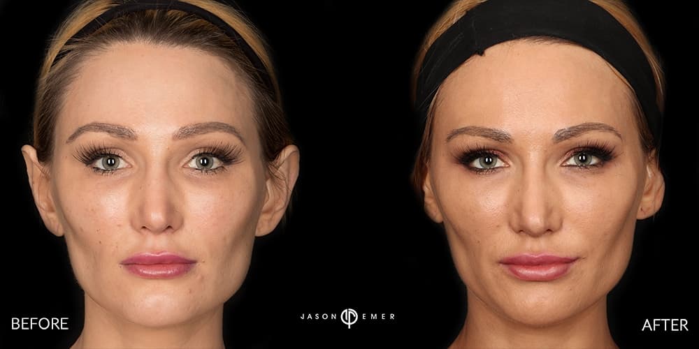 FACIAL SCULPTING FEMALE GALLERY