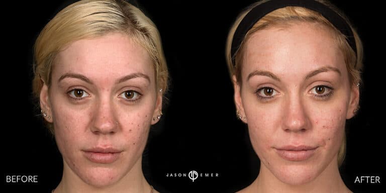 LASER SKIN RESURFACING GALLERY 01