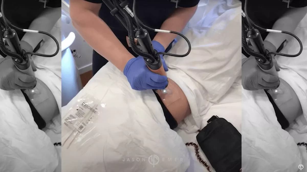 tattoo removal
