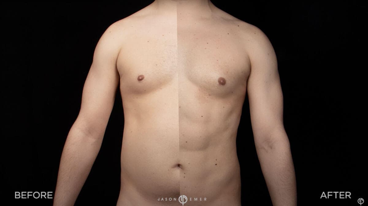 Arm Liposuction
