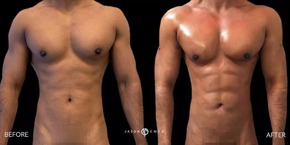 High Definition Liposuction