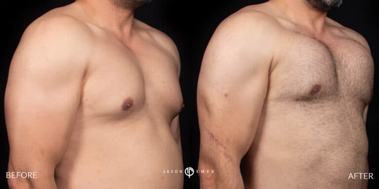 Chest Male Gallery 02