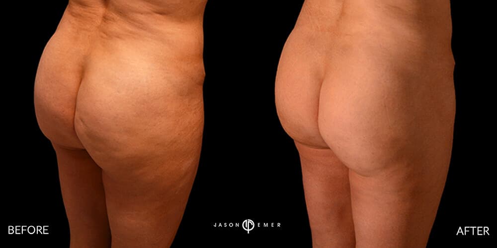 Cellfina before and after by Dr. Jason Emer in Beverly Hills