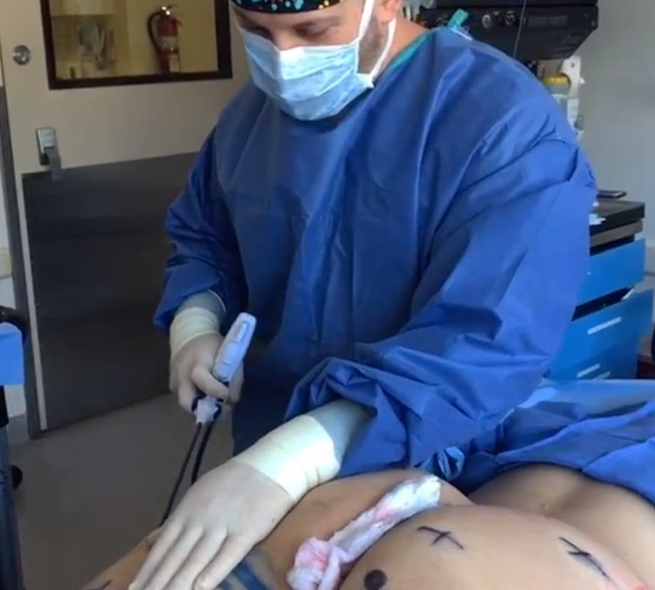 Thigh Lift & Tightening
