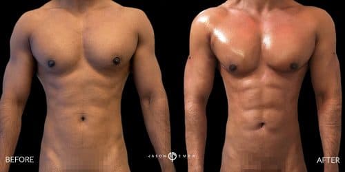 Hi-Definition Liposuction