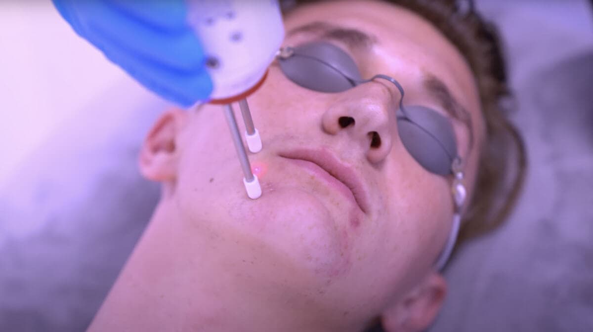 acne & general scars