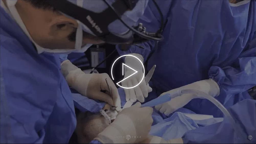 BUCCAL FAT REMOVAL FOR MEN