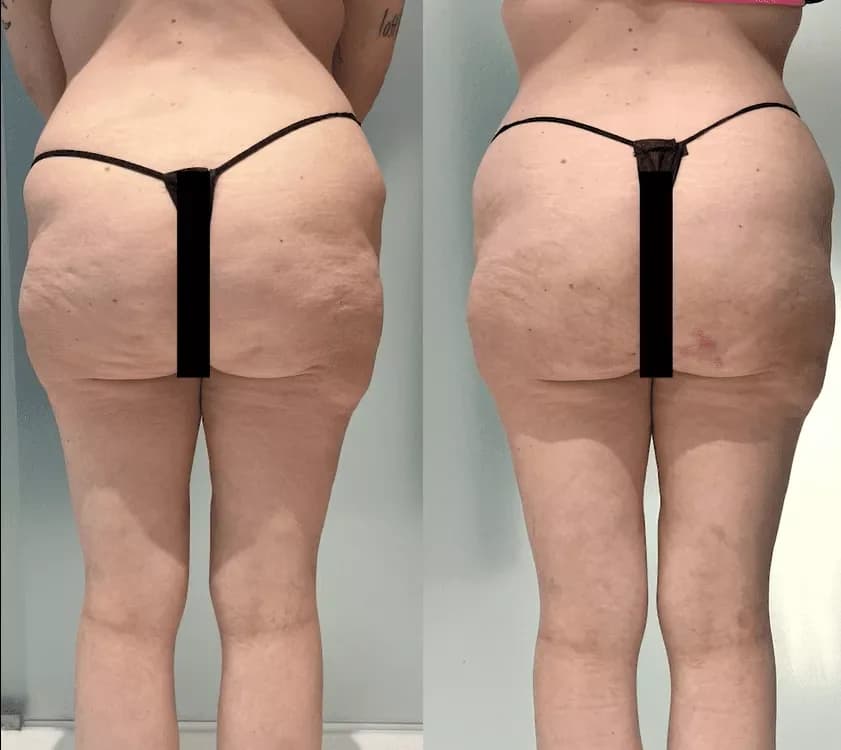 Enhanced Cellulite Reduction before and after by Dr. Jason Emer in Beverly Hills