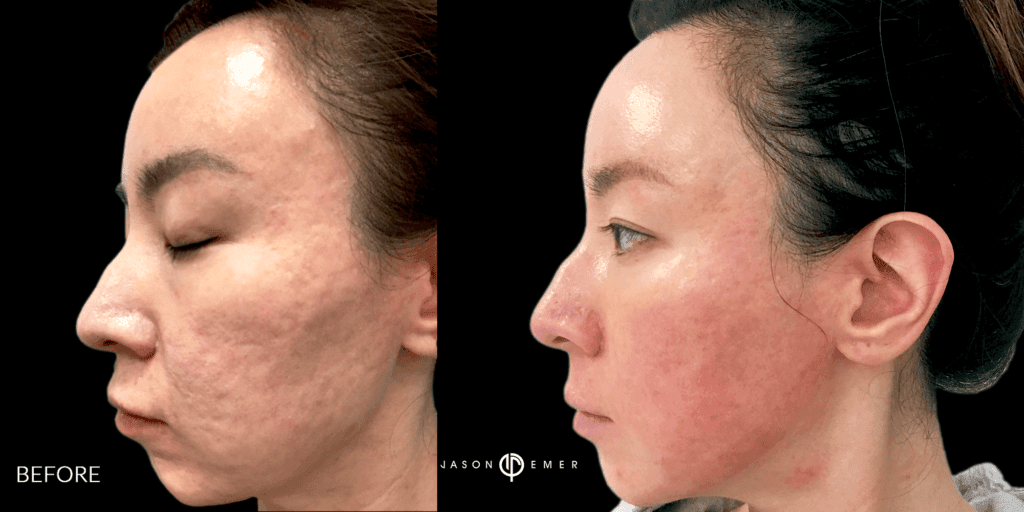 MICRONEEDLING