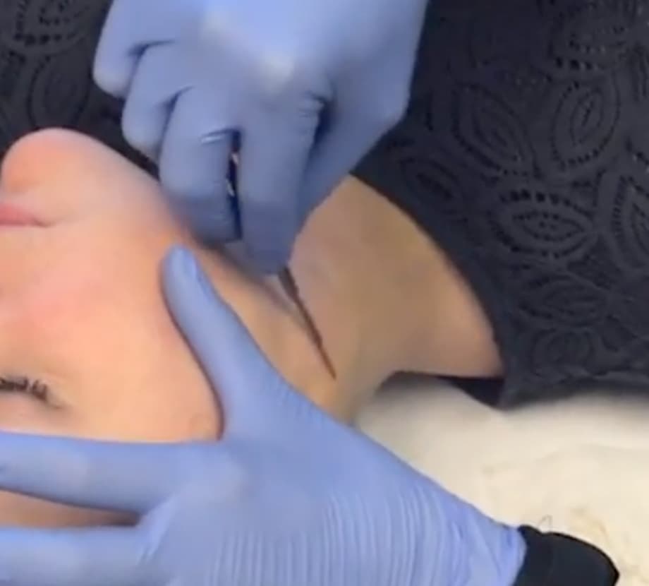 dermaplaning