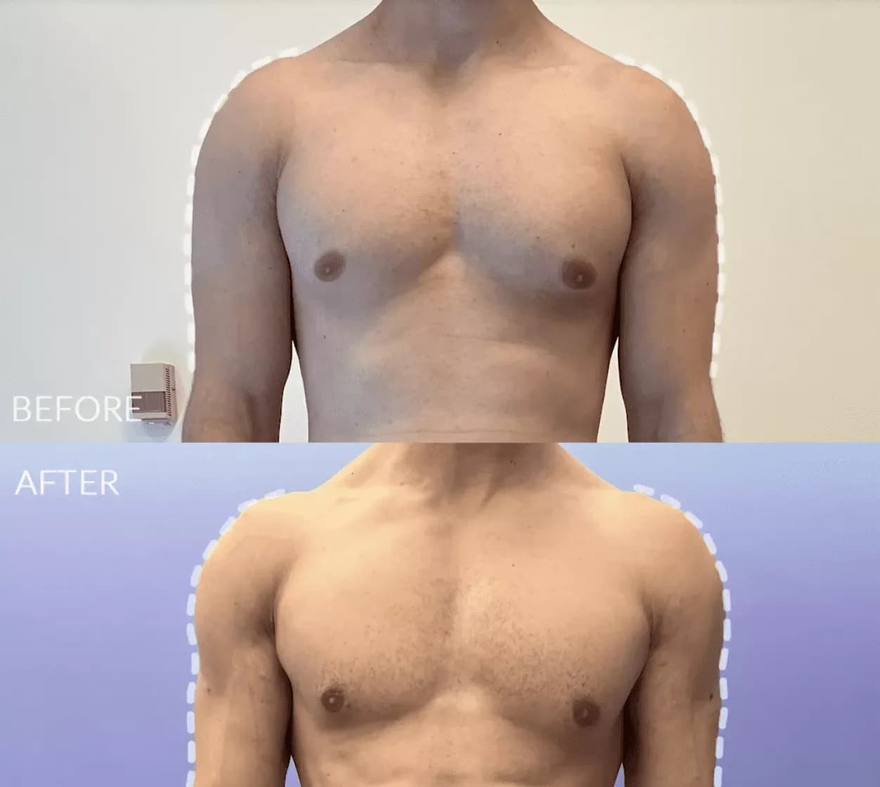 360 HD Liposculpture before and after by Dr. Jason Emer in Beverly Hills