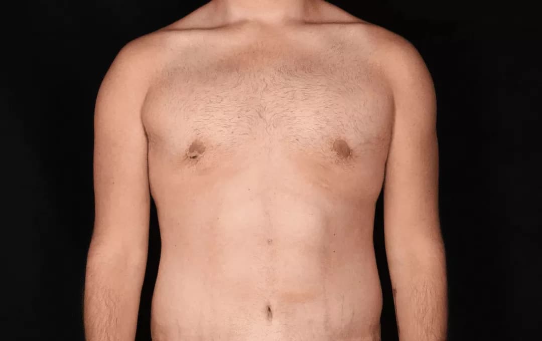 360 HD Liposculpture with Dr. Jason Emer in Beverly Hills