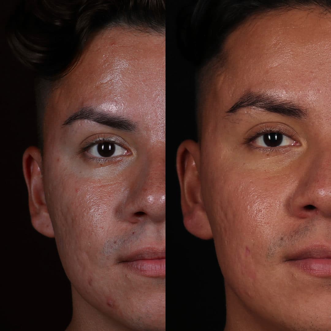 Microneedling editorial composite — aesthetic skincare gallery