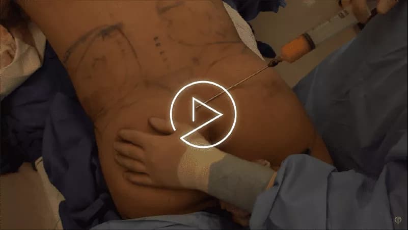 Back Lipo for Men before and after by Dr. Jason Emer in Beverly Hills
