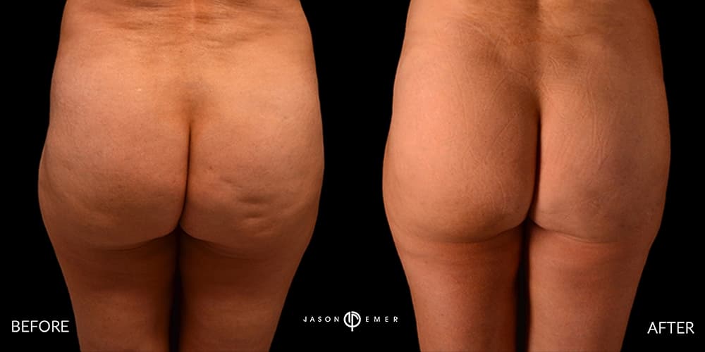 Cellulite Reduction