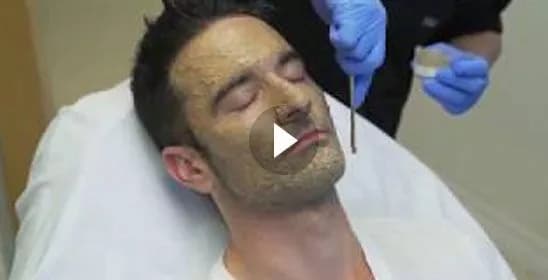 MELASMA