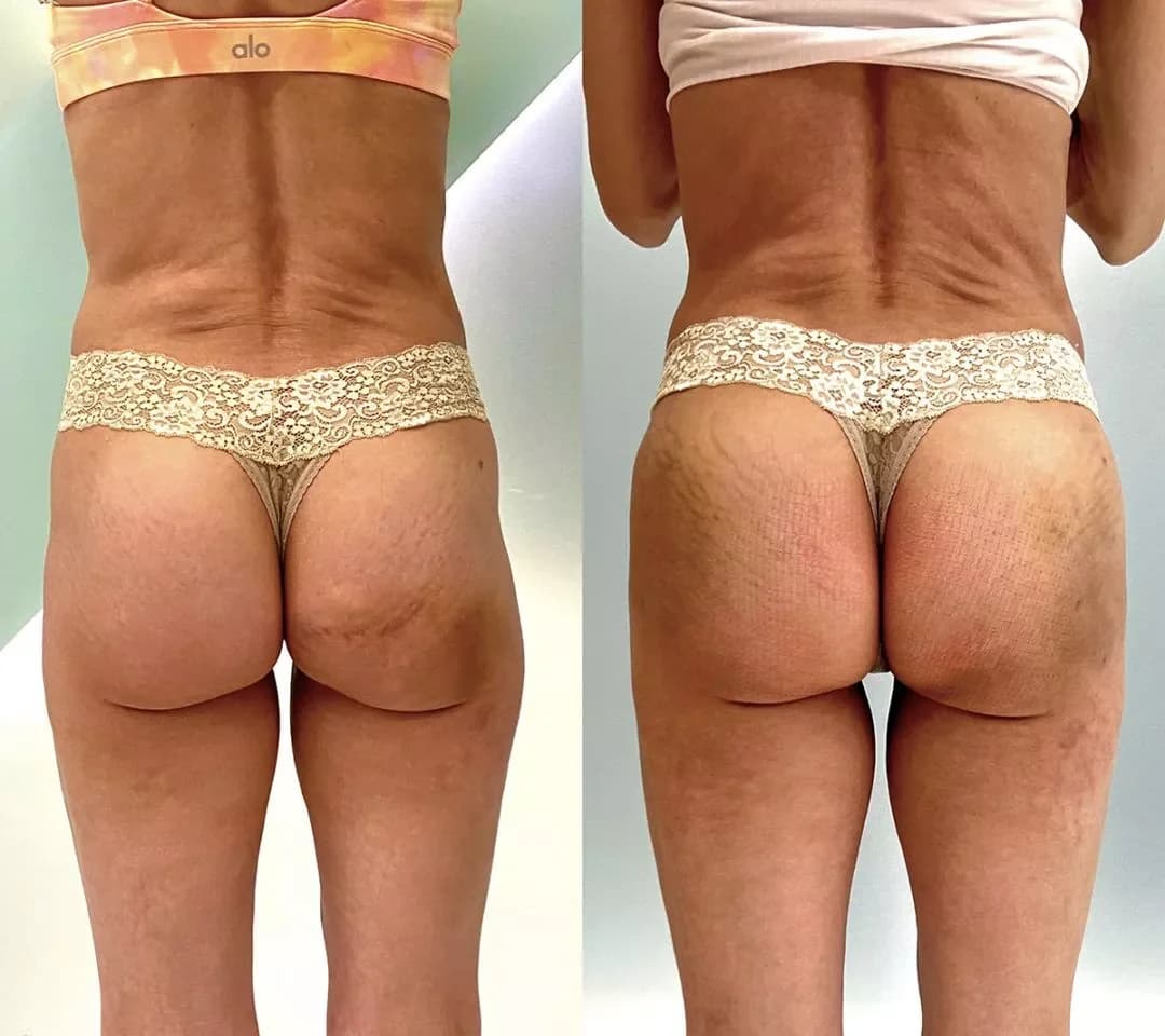 Fat Transfer before and after by Dr. Jason Emer in Beverly Hills