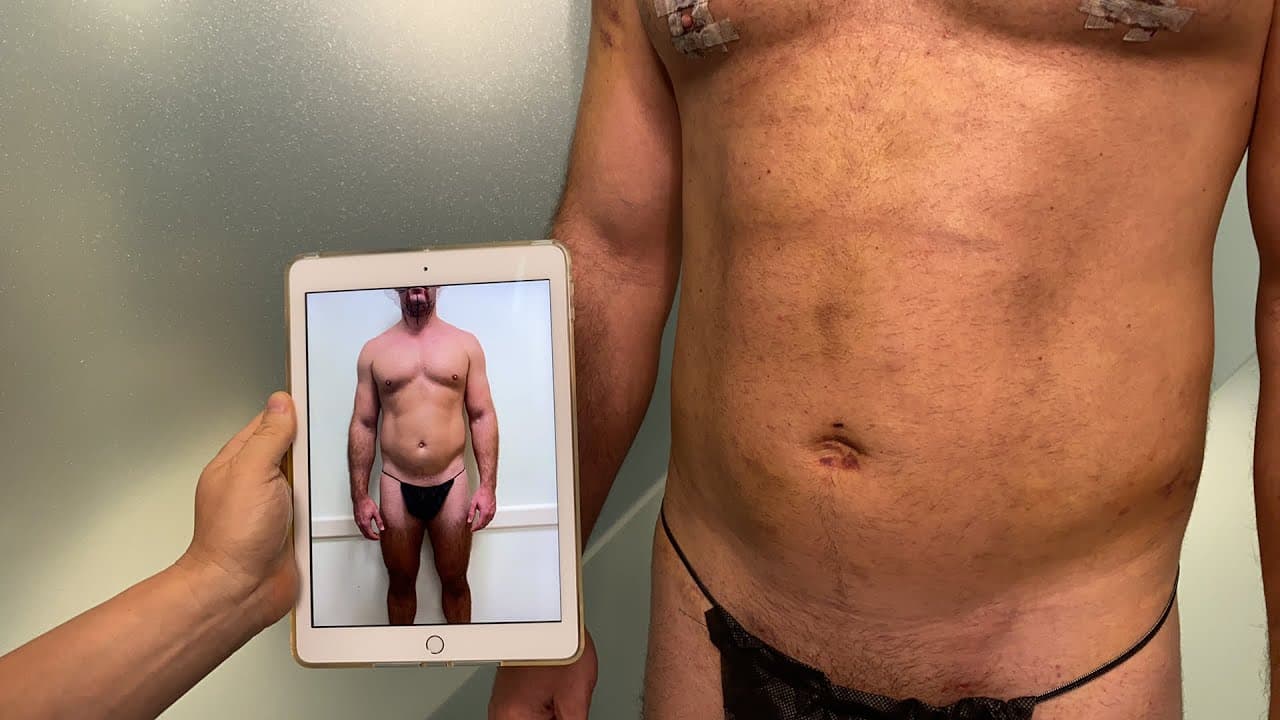 Watch a arm liposuction lp procedure video