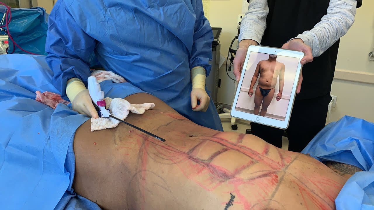 Watch a abdominal lipo for men lp procedure video