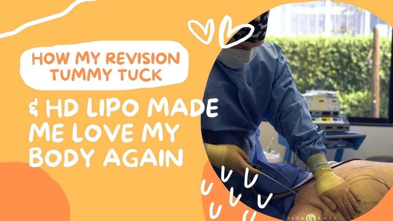 Watch a abdominal lipo for women lp procedure video