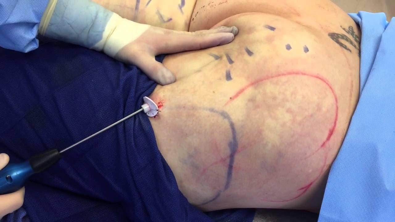 Patient story video 5